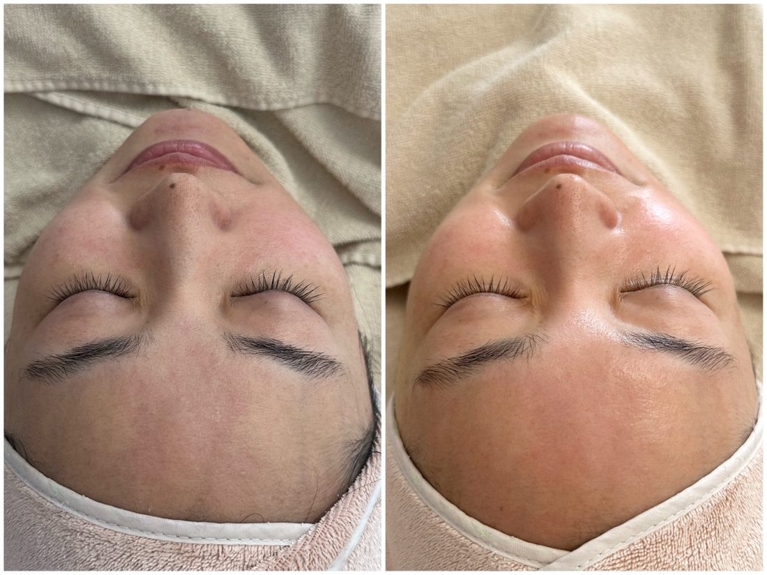 毛穴ケアの施術前・施術後の比較事例
